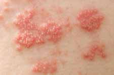 Shingles facts, suggestions and information about Shingles prevention, treatment and symptom relief
